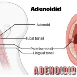 adenoidid